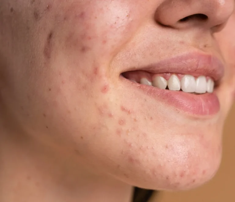 علاج البقع السوداء