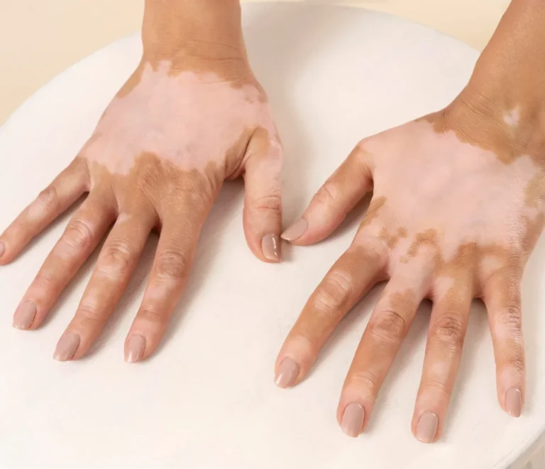 علاج البهاق، الصدفية، والأكزيما